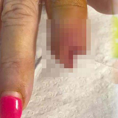 Melbourne Woman Forced To Have Finger Cut Off